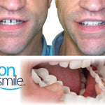 Carillas Postiza Dentadura SnapOn Smile