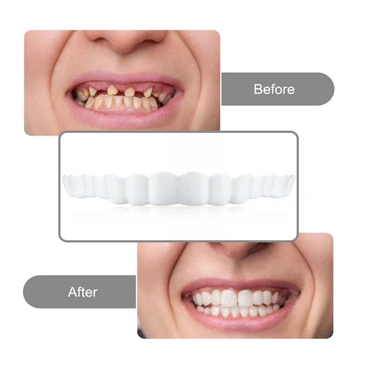 Carillas Postiza Dentadura SnapOn Smile