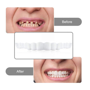 Carillas Postiza Dentadura SnapOn Smile
